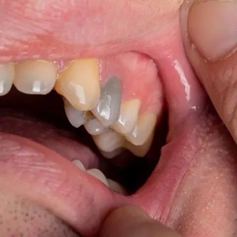 Primer plano intraoral de un diente anterior oscurecido junto a la encía